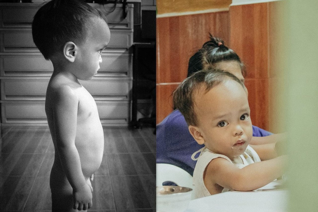 center for malnourished children 02